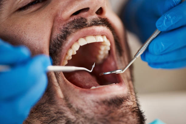 Best Emergency Dentist for Lost Fillings or Crowns in Lake Isabella, CA